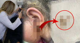 3 yaşındaki kızı kulak kaşıntısıyla hastaneye götürdüler: Doktor, kulağından çıkanları görünce şok oldu! Tam 23 tane canlı canlı