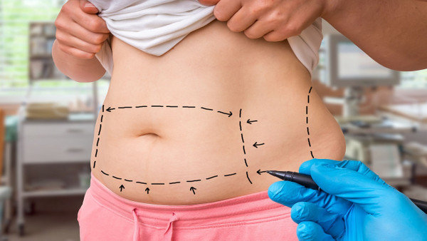 Liposuction Karın Germe Nasıl Yapılır?