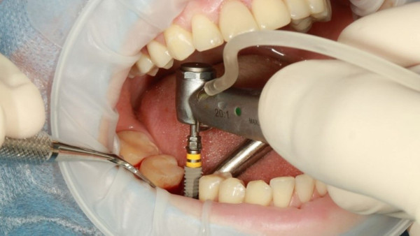 Diş implantları tehlikeli mi? En büyük tehlikesi nedir?