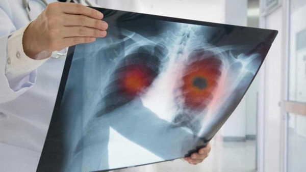 Doktorlar akciğer kanseri belirtileri için yeni açıklama yaptı bu 5 işarete dikkat!