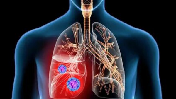 Akciğer kanserinin 9 belirtisi: Hayat kurtaracak uyarılar.. Uzmanlardan dikkat çeken uyarılar..