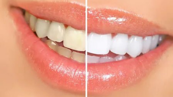 Dişleriniz için doğal bakım: Evde uygulayabileceğiniz 5 diş beyazlatma yöntemi