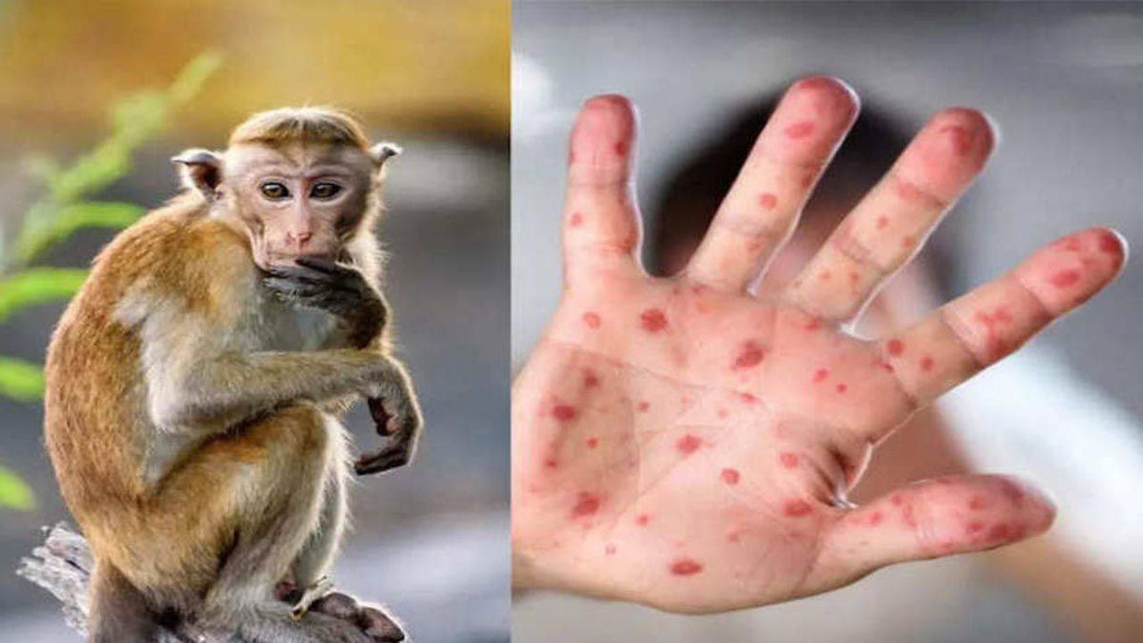 Maymun Çiçeği Hastalığında Yeni Dönem! Virüs Mutasyona Uğradı! Bambaşka Belirtiler Görülmeye Başladı - Resim : 1