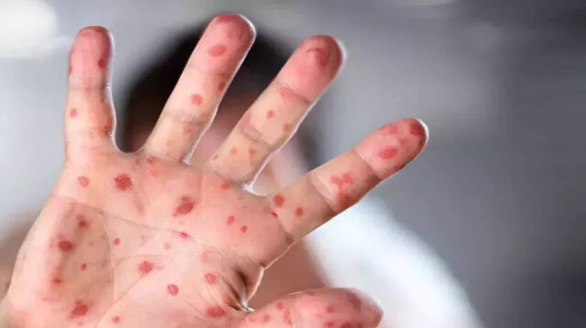 Türkiye Maymun Çiçeği virüsüne karşı hazırlıklara başladı: Sağlık Bakanlığı virüse karşı rehber kitapçık hazırladı! - Resim: 2