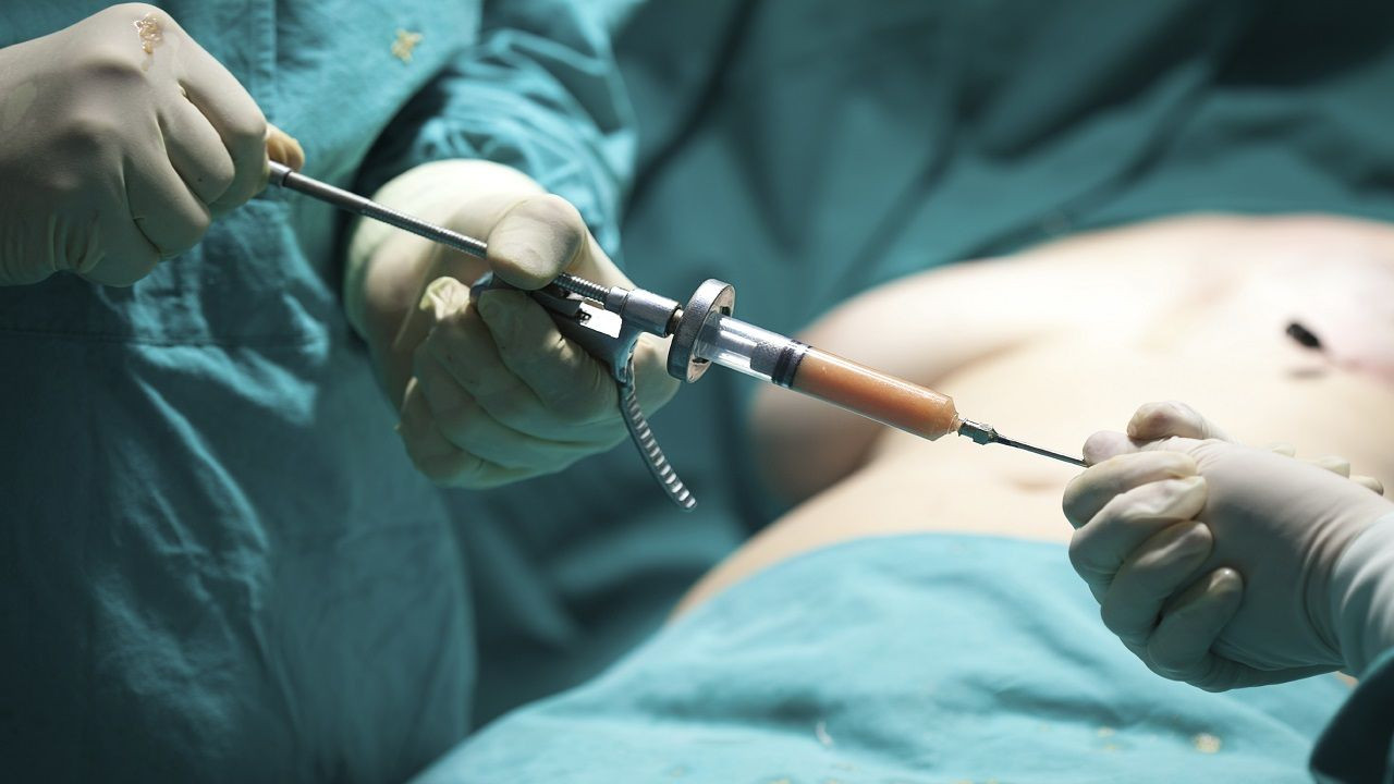 Liposuction Karın Germe Nasıl Yapılır? - Resim: 2