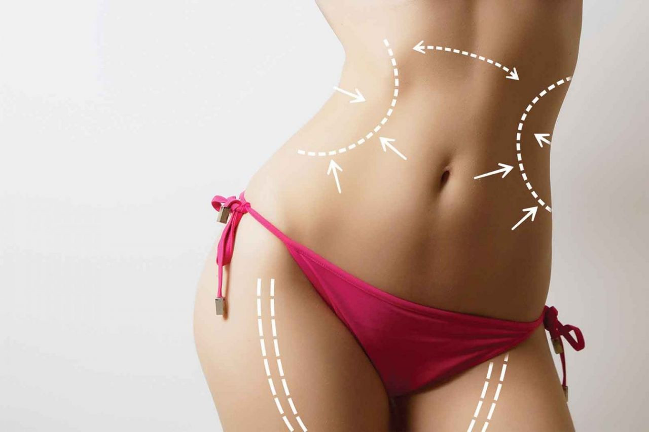 Liposuction Karın Germe Nasıl Yapılır? - Resim: 3