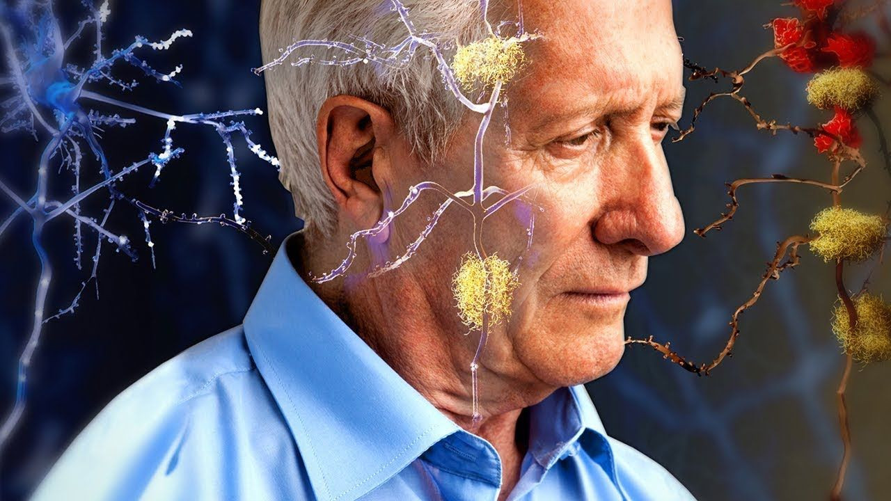 30’lu yaşlarda beyin yaşlanması “Alzheimer” hastalığını başlatıyor! Kalbi zayıf olanların bunama riski artıyor! - Resim: 4
