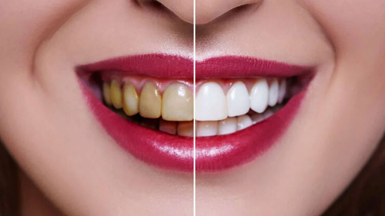 Sararan dişleriniz bembeyaz olsun: Evde dişleri parlatan mucize yöntem: Evde doğal formül ile ışıl ışıl parlayan dişlere sahip olun