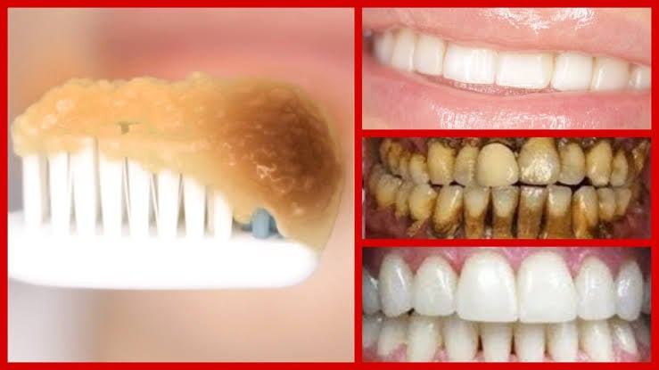 Sararmış Dişler Sadece 20 Dakikada Porselen Gibi Oluyor! Yüzde Yüz Çözüm İle Beyaz Gülüşe Kavuşun! - Resim : 2