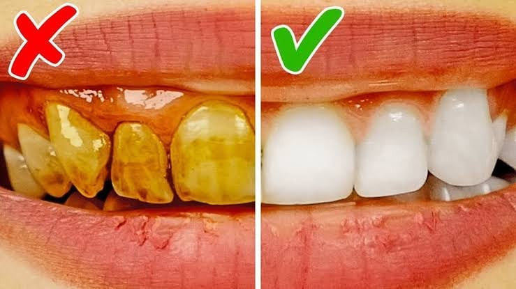 Sararmış Dişler Sadece 20 Dakikada Porselen Gibi Oluyor! Yüzde Yüz Çözüm İle Beyaz Gülüşe Kavuşun! - Resim : 4