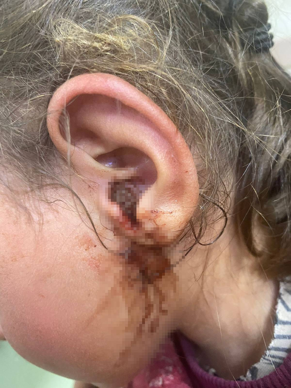 3 yaşındaki kızı kulak kaşıntısıyla hastaneye götürdüler: Doktor, kulağından çıkanları görünce şok oldu! Tam 23 tane canlı canlı - Resim : 3