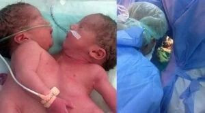 Ankara'da Nadir Görülen Bir Olay Siyam İkizleri Dünyaya Geldi! Doktorlar yeni doğan bebeği görünce.. - Resim: 1