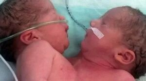 Ankara'da Nadir Görülen Bir Olay Siyam İkizleri Dünyaya Geldi! Doktorlar yeni doğan bebeği görünce.. - Resim: 2