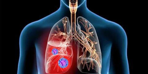 Akciğer kanserinin 9 belirtisi: Hayat kurtaracak uyarılar.. Uzmanlardan dikkat çeken uyarılar.. - Resim: 1