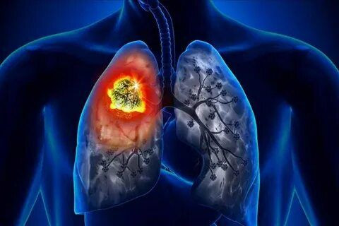 Akciğer kanserinin 9 belirtisi: Hayat kurtaracak uyarılar.. Uzmanlardan dikkat çeken uyarılar.. - Resim: 2